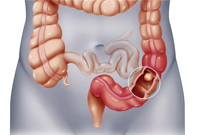 Tìm hiểu về ung thư đại tràng